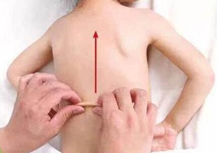 小儿捏脊疗法