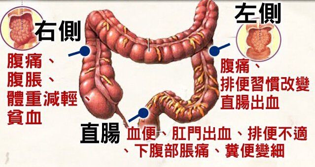 肠癌的早期症状