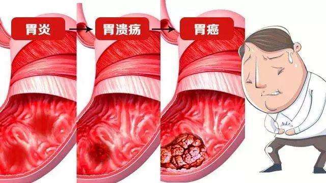 胃癌和胃溃疡都有哪些区别