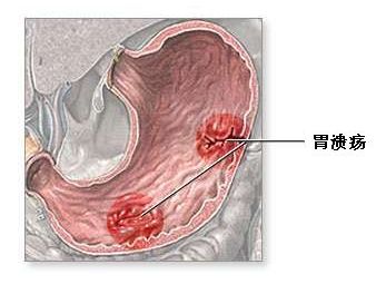胃溃疡发生病变的症状有哪些
