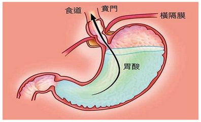 胃酸怎么回事引起胃酸的原因是什么