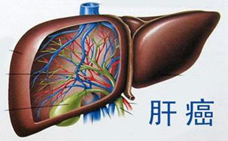 肝癌发展到后期会有哪些症状