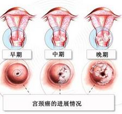 专家详解宫颈癌发生的诱因