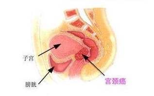 宫颈癌早期会出现哪些症状