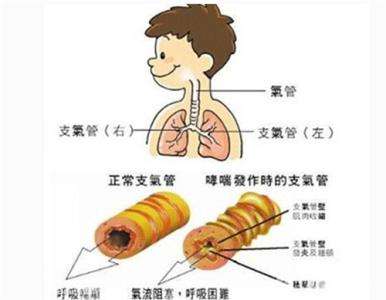 急慢性支气管炎是怎么回事