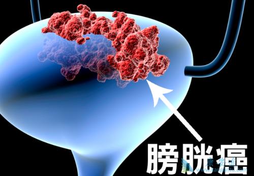 膀胱癌早期有哪些症状