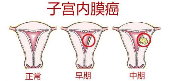 子宫内膜癌的危害有哪些