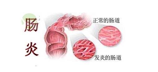 急慢性胃肠炎的症状有哪些
