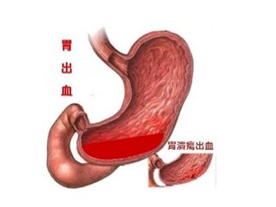 胃出血的早期症状有哪些
