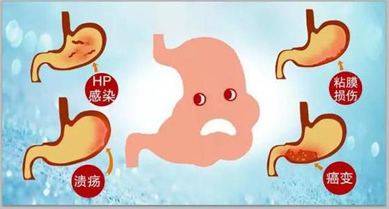 糜烂性胃炎的特征有哪些