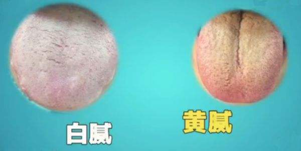 造成舌苔厚白的原因是什么