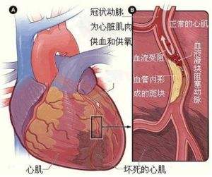 心肌梗死的症状都有什么