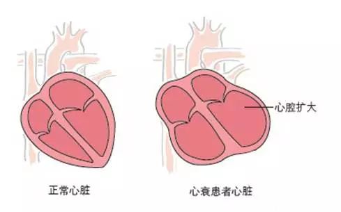 心衰的症状表现有哪些