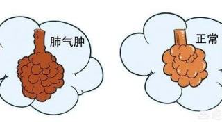 诱发肺气肿的原因有哪些