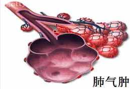 肺气肿的症状表现具体有哪些