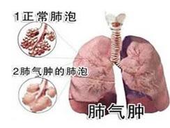 肺气肿的症状有哪些
