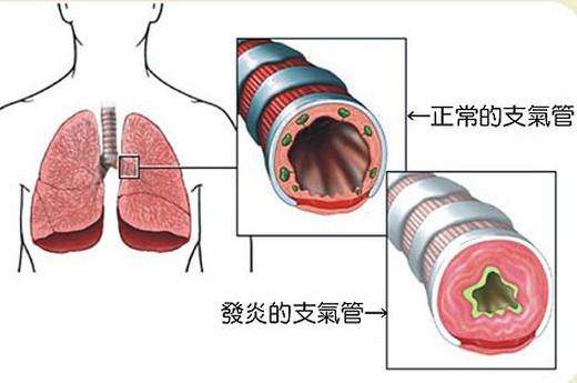导致支气管炎的病因有哪些