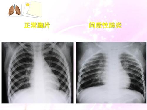 间质性肺炎护理注意事项有哪些