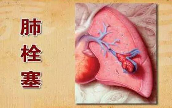 肺栓塞的症状有哪些
