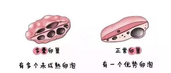 什么是多囊卵巢综合症