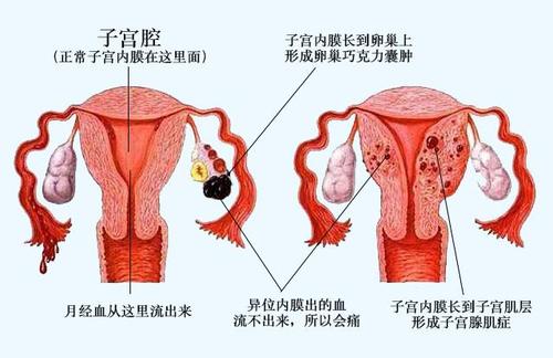 子宫内膜异位症治疗方法是什么