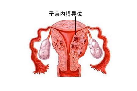 子宫内膜异位症有哪些危害