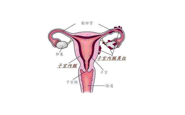 造成子宫内膜异位症的原因是什么