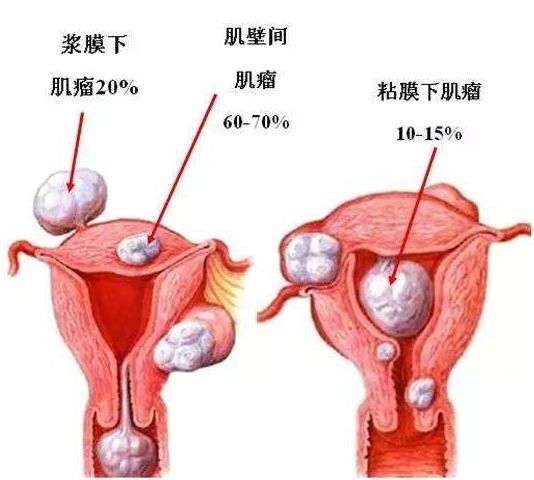 子宫肌瘤早期症状有哪些明显的表现