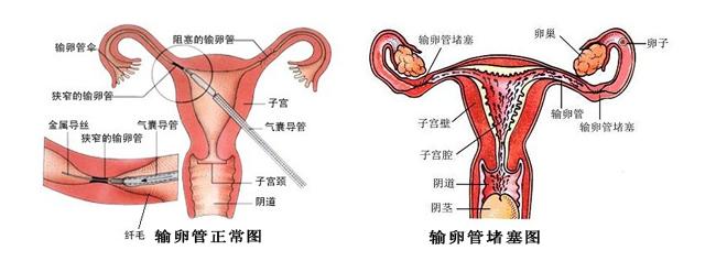 中医怎么治疗输卵管堵塞