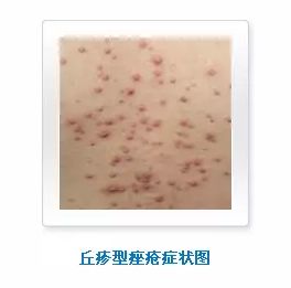 痤疮的症状有哪些