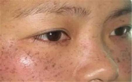 长黄褐斑的原因有哪些