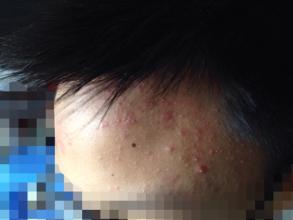 毛囊炎症状是怎样的
