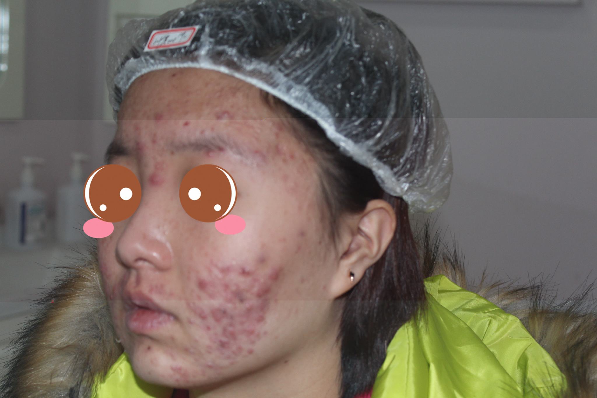 青春痘的症状有哪些