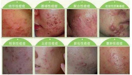 青春痘的发病原因及护理注意事项有哪些