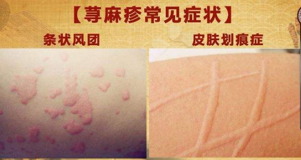 荨麻疹的症状有哪些