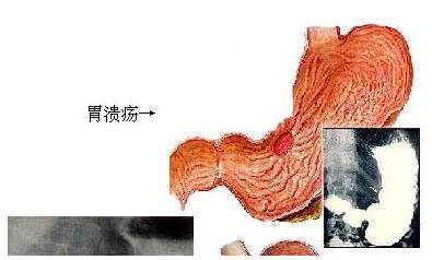 浅表性胃溃疡的症状有哪些?怎么治疗?