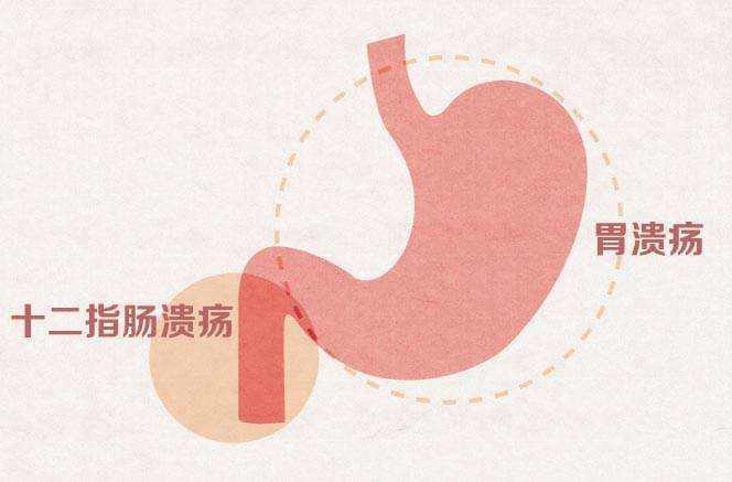 如何区分胃溃疡和胃癌呢?