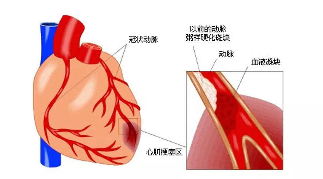 盛夏防范心脑血管疾病要注意这5点！