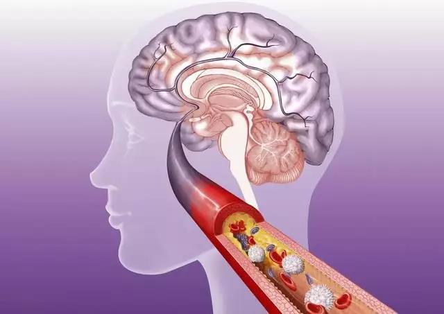 经常出现这3种症状，可能是脑梗塞的前兆?