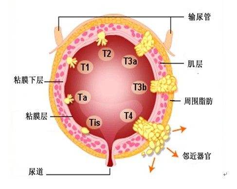 膀胱癌后期怎么护理才能避免复发和转移?