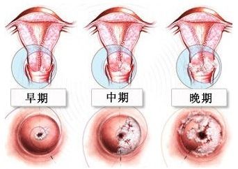 宫颈癌早期临床表现是什么?