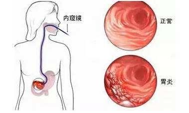 糜烂性胃炎的病因？糜烂性胃炎有什么症状?