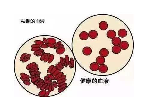 有什么治疗高血脂的好办法？