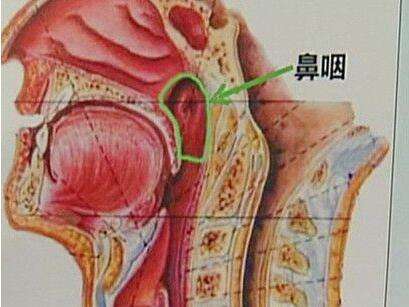 得了鼻咽癌有哪些早期症状表现?