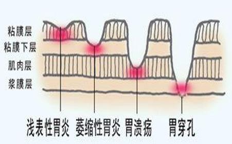 糜烂性胃炎的症状有哪些?