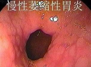 慢性萎缩性胃炎伴糜烂该怎么治疗？
