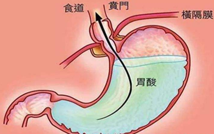 经常胃酸怎么回事？胃酸过多会怎么样？