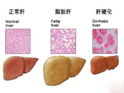 脂肪肝到肝癌需要多久？
